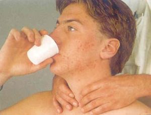 лечение щитовидки радиактивным йодом