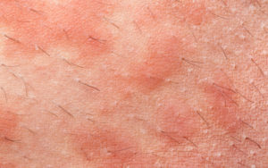 аллергическая сыпь при передозировке эутирокса
